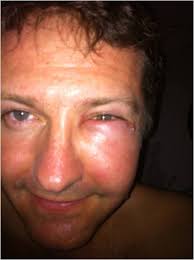 Entomology PR: All about bee stings