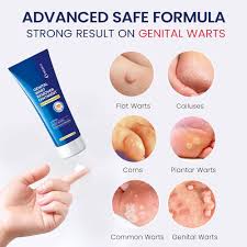 Image result for genital warts