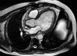 Image result for Cardiac MRI