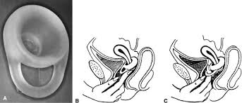 Use And Effectiveness Of Barrier And Spermicidal Contraceptive Methods Glowm