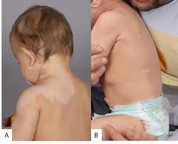 Typisch sind anfänglich braunrote (pityriasis versicolor rubra), makulöse, ovale und kreisrunde, konfluierende, flache, konfigurierte, scheinbar nicht schuppende läsionen. Weisse Flecken Bei Kindern Diagnostischer Uberblick Padiatrie Schweiz