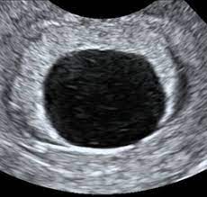 Dating scan that uses very early on obstetric scans. Viability Scan Ultrasound Scans Welcome To The Fetal Medicine Centre