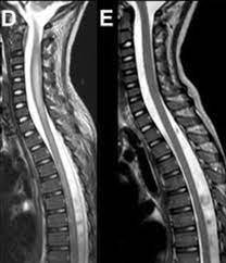 Rare neurological complications include transverse myelitis and/or cauda equina syndrome 20, 21; Acute Flaccid Myelitis Wikipedia