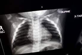 X Ray For Kids Choc Children S Hospital Orange County
