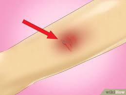 As long as the bleeding is stopped in time and no serious infections develop, even some of the more damaging gunshot wounds will not be fatal. How To Treat A Graze 14 Steps With Pictures Wikihow