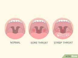 Image result for Strep throat infection roof of mouth