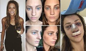 Rhiannongetsrhino Blogger Shares Her Diary Of A Nose Job Nose Job Nonsurgical Nose Job Rhinoplasty