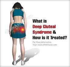 What Is Deep Gluteal Syndrome How Is It Treated