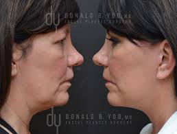 After lil' kim posted an instagram photo of her latest look, people were shocked by the rapper's total transformation from her early days. Beverly Hills Facelift Specialist Dr Donald Yoo Performed A Deep Plane Facelift This Before And After Face Lift Surgery Facial Plastic Surgery Facial Plastic