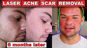 We did not find results for: Acne Scar Removal Before And After 6 Months Fractional C02 Laser Skin Resurfacing Youtube