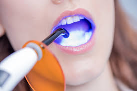 Partial dentures, in general, can be used to replace one or multiple teeth. Dental Bonding Cost Of Adhesive Direct Composite Bonding