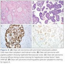 It occurs predominantly in women and most often arises from the peritoneal surfaces of the pelvis, but it has been reported to occur in the pleura, pericardium, and tunica vaginalis ( , 1 ). Morphologic Immunophenotypic And Molecular Features Of Epithelial Ovarian Cancer