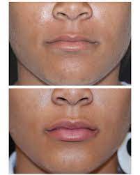 We did not find results for: 11 Things I Wish I Knew Before Juvederm Juvederm Forum