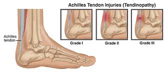 Learn its anatomy and function now at kenhub! Physical Therapy Guide To Achilles Tendinopathy Choosept Com