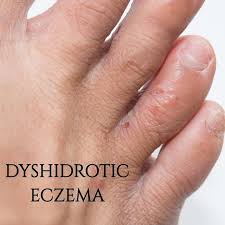 Image result for dyshidrosis