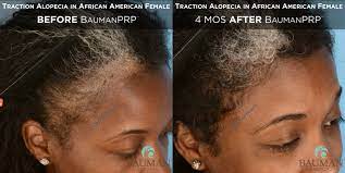You'll find tips that dermatologists give their patients at: Traction Alopecia In African American Baumanprp Bauman Medical