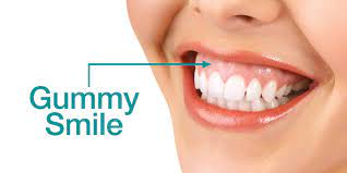 The photos below are before starting the braces process and after fully finished with the procedure. Can A Gummy Smile Really Be Fixed Malmin Ortho