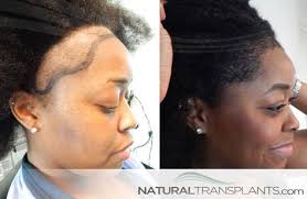 Best Hair Replacement Surgeon in West Palm Beach, Florida