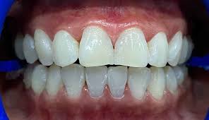 It is considered to be the fastest and most effective form of teeth whitening. Zoom Teeth Whitening In Dubai For A Brighter Smile Dental Studio