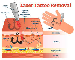 Image of different laser technologies used in tattoo removal