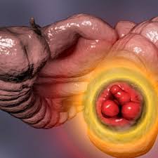 Image result for blood in stool human poop