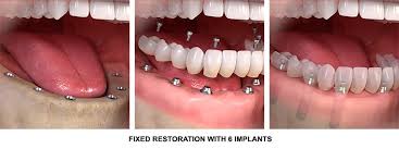 Full Mouth Dental Implants All On 6 Dental Implants Implant Dentist Nyc