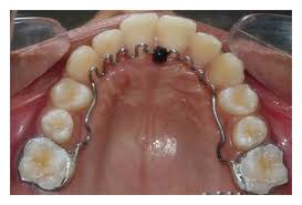 Tongue thrust is a common form of orofacial muscular imbalance and a human behavioral pattern in which the tongue protrudes forward through the usually, the habit of tongue thrust disappears when a baby is of six months old and starts eating solid food. Habit Breaking Appliance For Multiple Corrections