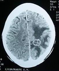 We evaluated retrospectively the ct scans of 13 patients who were treated with brachytherapy for malignant glioma. Brain Tumor Wikipedia