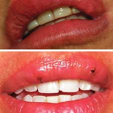 Washing your face strictly with warm water until the cold sores disappear. Above Small Lumps In The Lip After Injection Of Radiesse Into The Download Scientific Diagram