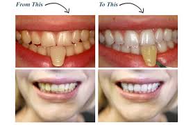 Here's how to whiten teeth with braces Savannah Teeth Whitening Kor Whitening Deep Bleaching