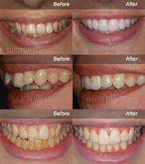 Kissdental is your trusted dentists in manchester that offers dental treatments including teeth implants, crowns, and cosmetic dentistry. Inman Aligner Bury St Edmunds Fast Teeth Straightening