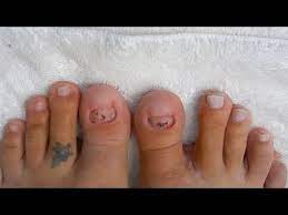 Nail Bed Prep For No Toenails Wear Update On Acrylic Toenails W Dual Forms Part 1 Youtube