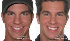 The price of braces in rands range from r6,000 to r25, 000 for children and r6,000 to r50,000 for adults, the price is dependent on the design and specification. Affordable Gentle Dentist Umhlanga