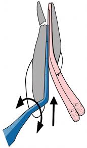 The use of finger spreaders, hand and heated pluggers have greatly improved the dentists' ability to apply this gutta percha. Complications Due To Root Canal Filling Procedures Springerlink