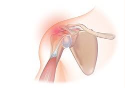 Image result for Rotator Cuff Rupture