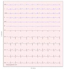 P waves normal for the subject. Ecg Interpretation Characteristics Of The Normal Ecg P Wave Qrs Complex St Segment T Wave Ecg Echo