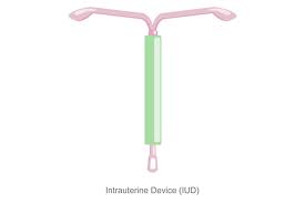 Rund sieben millionen frauen in deutschland schlucken sie täglich. Levosert Noch Eine Neue Hormonspirale