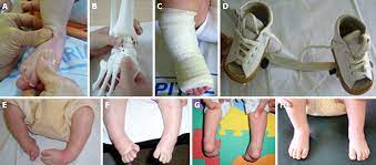 Given the challenges of treating talipes equinovarus, this author offers a closer look at the evolution of the ponseti method, keys to successful we should no longer regard treatment of idiopathic clubfoot as an orthopedic emergency. Functional Physiotherapy Method Results For The Treatment Of Idiopathic Clubfoot