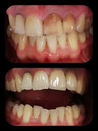 Gingiile reprezinta locul de implantare al radacinilor dintilor. Sample Page Paris Dental Clinic
