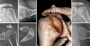 Bigliani claudio is on facebook. Impingement Syndrome Der Schulter Springerlink