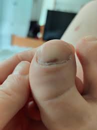 People should check for symptoms of melanoma and other skin cancers every month. 42f Toe Nail Discoloration Suddenly Appeared I Am A 2x Cancer Survivor It Doesn T Hurt But Looks Like It Is Really Under The Nail Does Anyone Recognize This Melanoma