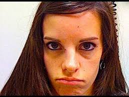 Broken nose treatment may include procedures that realign your nose. Broken Nose 10 7 09 217 Youtube