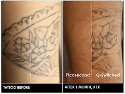 Laser tattoo removal works by targeting pigment colors in the skin's dermis, the layer of skin between the epidermis and subcutaneous tissues. 5 Tips For Speeding Up Your Tattoo Removal
