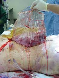 Kaufen, verkaufen und sammeln auf ebay war noch nie so aufregend! Abdominal Compartment Syndrome And The Open Abdomen Musculoskeletal Key