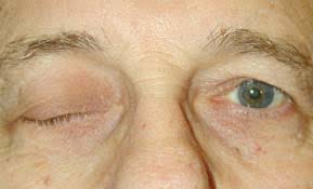 Image result for Pupillary Paralysis
