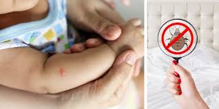 If you are wondering what has bitten your child, here is a. Bed Bugs Can Be Dangerous For Your Kids What To Do About Bedbug Bites On Toddlers