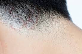 Acnes is elevated in aga hair follicles. The Complete Guide To Dealing With Sebum Buildup Hair World Magazine