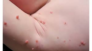 Molluscum contagiosum is a common viral skin infection that causes skin lumps, which can be itchy. Mollescum How It S Spread And How To Avoid