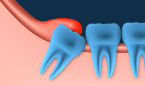 If you are like most people, you may not give… Pericoronitis Gum Infection Associated With Wisdom Teeth D4dentist