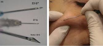 This paper reviews recent studies on pathogenesis and treatment approaches to this disease. Subcision For Acne Scars Expert S Guide To Effective Acne Scar Treatment In Singapore
